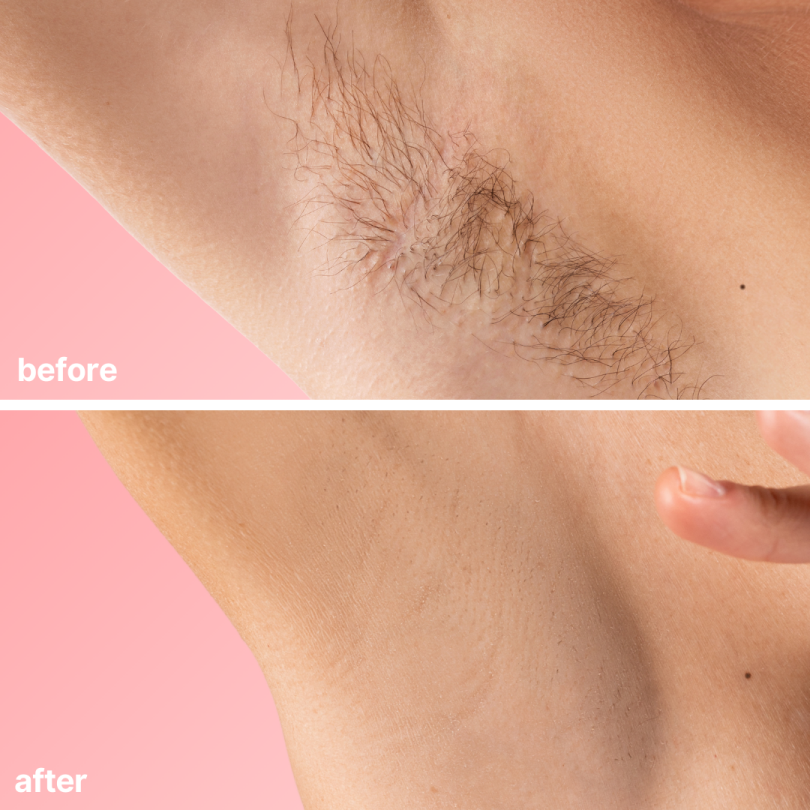 🔥 Final Day 50% OFF 🔥- Official Store💎KINGURR ® Bare Basics No Shave Hair Removal Cream