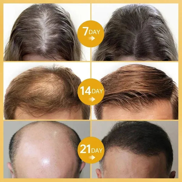 🌸🧧 (Spring Festival Sale – Huge Discounts!) 🐉🎊LOVILDS™ Rosemary Hair Growth Essence – Natural Hair Growth Formula🌱